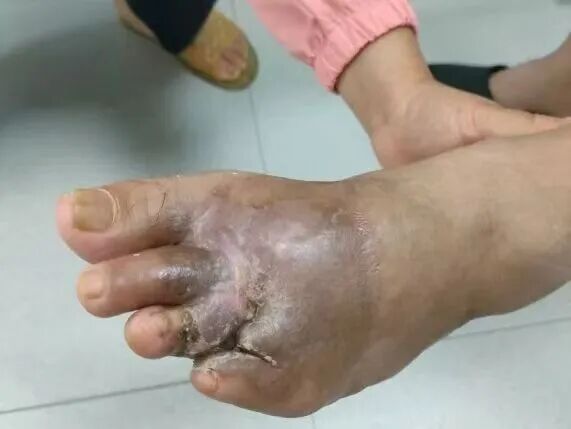 险遭截肢!5E对战
这家医院全力以赴,成功为重伤患者保住行走能力 险遭截肢!5E对战
这家医院全力以赴,成功为重伤患者保住行走能力